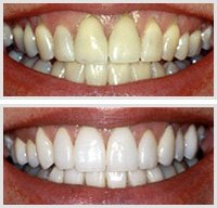 LVWhitening's tweet photo. #RETWEEETME  If UR N the las vegas area and would like to get ur teeth whitened!! We will be giving away1 whitening! https://t.co/JRyfP0f4vq