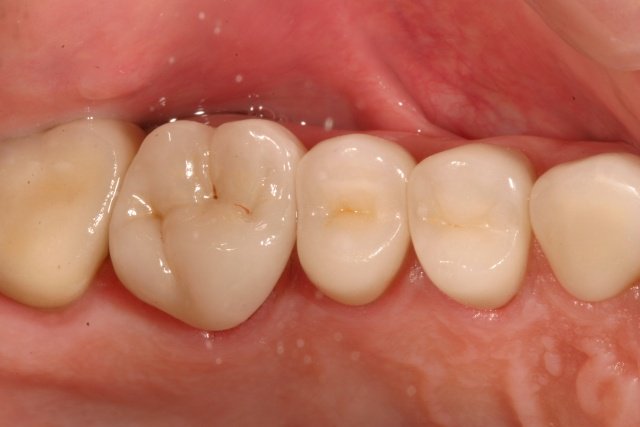 SpearEducation's tweet photo. Get More Predictable Results with Translucent Zirconia: https://t.co/xiLd7AoWW1 #dentistry #dental https://t.co/K92d5uJoiJ