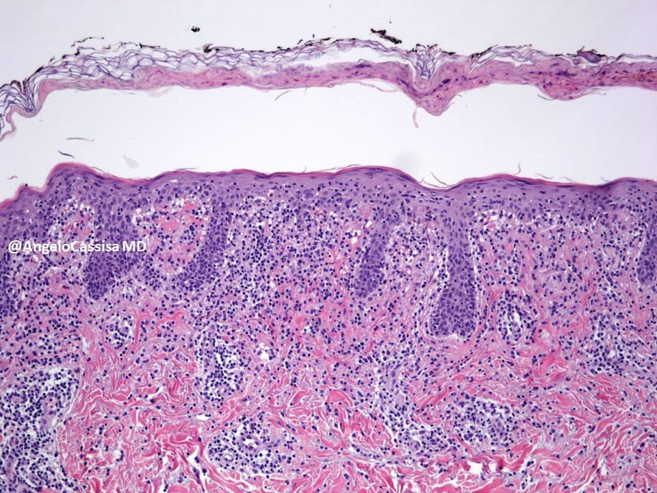 AngeloCassisa's tweet photo. IDM2016 peppered epidermis in pityriasis lichenoides et varioliformis acuta #PLEVA #dermpath https://t.co/hi4D7FYdMx
