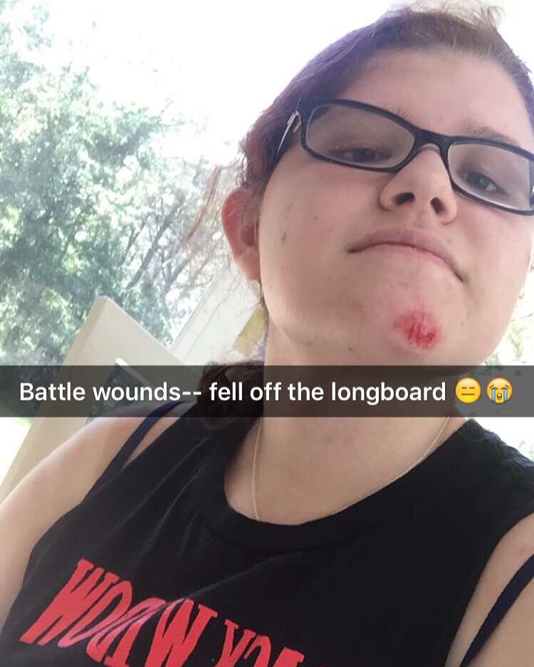 //I've had a bad fall off my longboard
