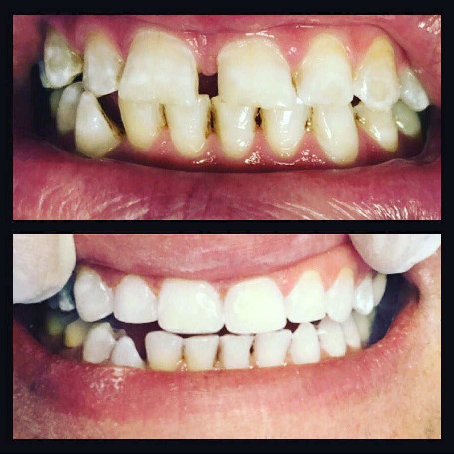 #estheticdentistry #smile #gülümse#lazer #beyazdolgu #gülüştasarımı #smiledesigne #dentakraft #dtderyaperçin