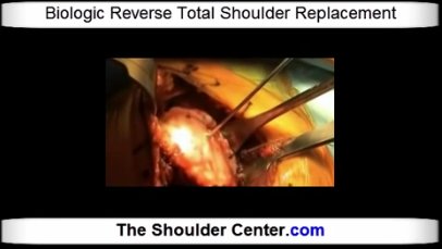 theshoulder's tweet photo. Biceps tendon pain treatment https://t.co/fYS9Vl5glx #biceps #tendon #bone #muscle #treatment #medicine https://t.co/deXP87yUq0
