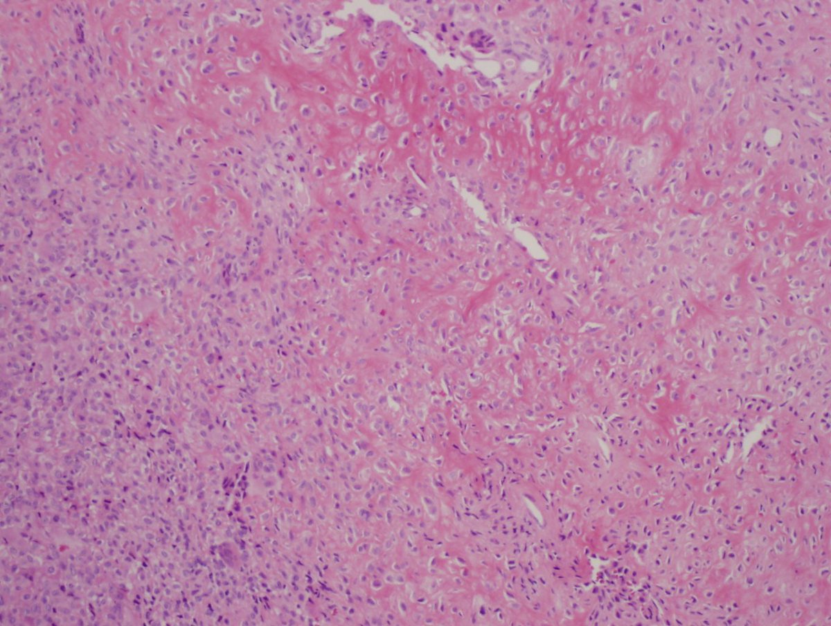 smlungpathguy's tweet photo. Chondroblastoma #bstpath #pathboards #knoworfail pink chondroid matrix, giant cells, grooved nuclei, epiphysis https://t.co/Z42PKTv97u