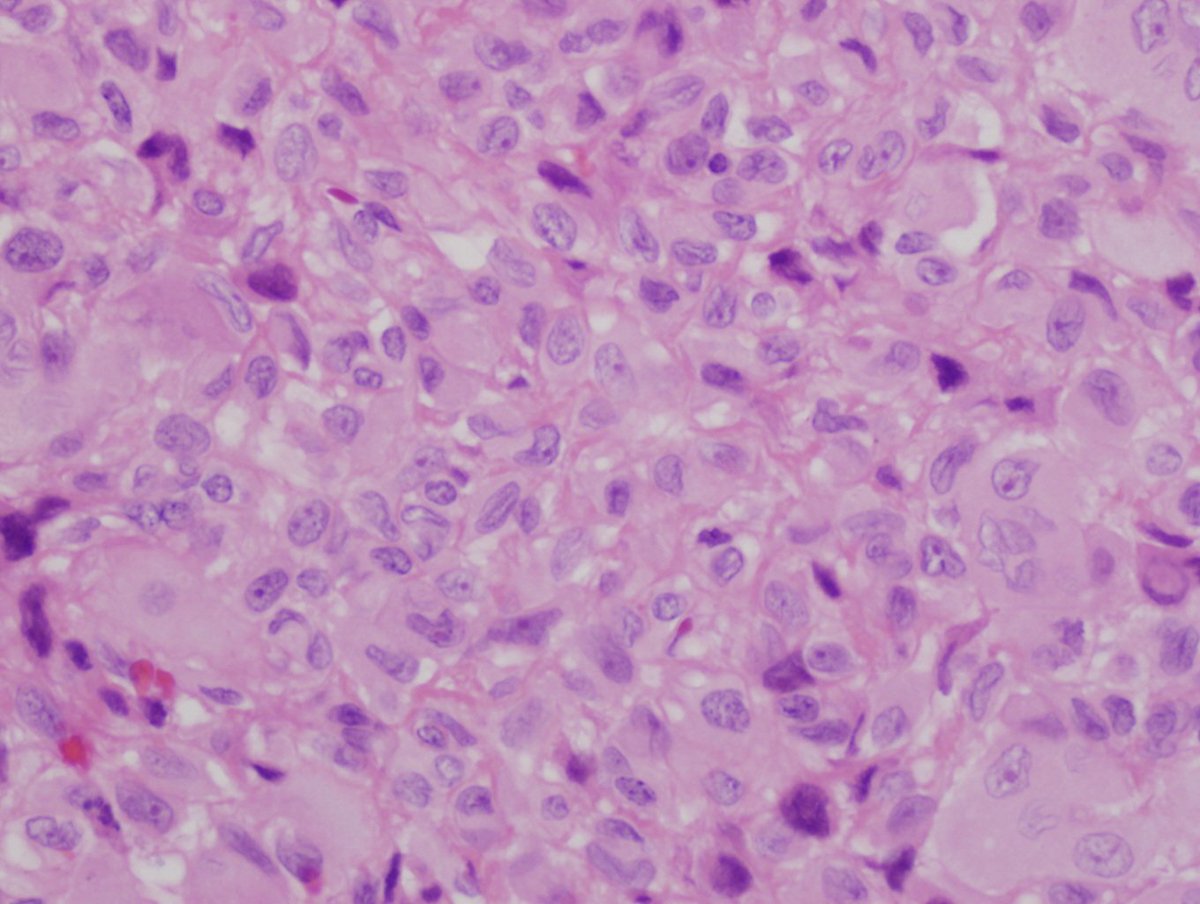 smlungpathguy's tweet photo. Chondroblastoma #bstpath #pathboards #knoworfail pink chondroid matrix, giant cells, grooved nuclei, epiphysis https://t.co/Z42PKTv97u