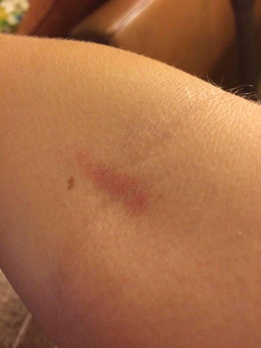 fencer_probs's tweet photo. Coach: we'll be working on counter attacks today 
Me: so my arms going to look like this all week
#fencingprobs https://t.co/bwQNpTlffo