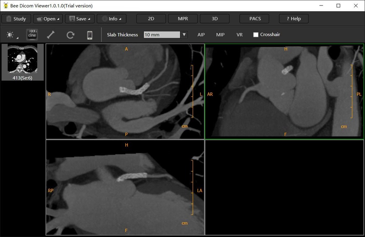 Oblique MPR. Get more information