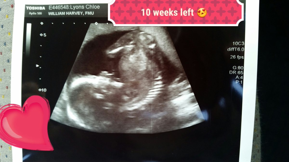 ChloeLyons09's tweet photo. @kelvin_banfield 10 weeks left till our beanette is here #exciting xxxx https://t.co/sSwolrs4cp