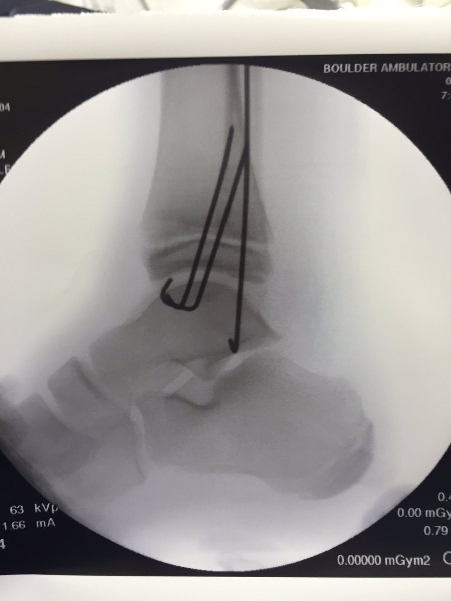 ERGoddessMD's tweet photo. "It's throbbing."
I bet it is sweetie. 
#PostOpProbs https://t.co/nurCmS38Ht