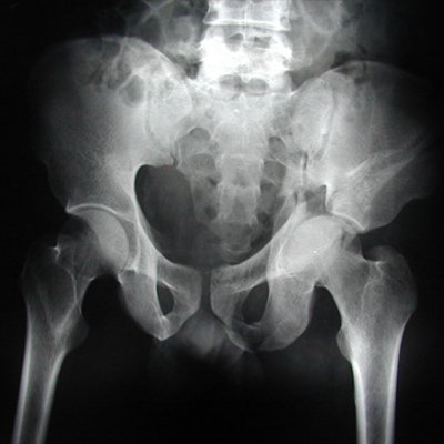 jointsmasters's tweet photo. 3 D imaging gives better understanding of #SocketFracture resulting in precise surgery, hence better outcome https://t.co/RIA9UhsmRi