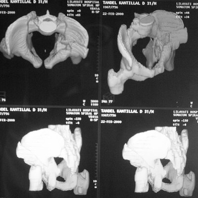 jointsmasters's tweet photo. 3 D imaging gives better understanding of #SocketFracture resulting in precise surgery, hence better outcome https://t.co/RIA9UhsmRi