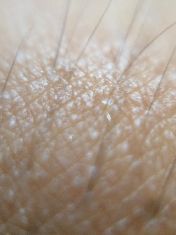 Ci_Kos's tweet photo. Skin investgated via muEye (25x) #muiset #clownfunding #startup #innovation #portableMicroscope https://t.co/J74PpJ0wgZ