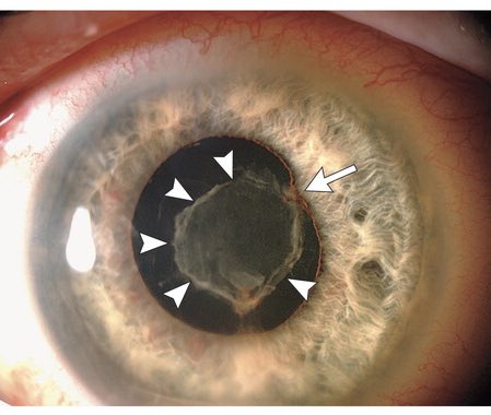 DianaShibaMD's tweet photo. Sepsis and the Eye: Hypopyon via the New England Journal of Medicine, on Klebsiella @NEJM https://t.co/8R0cd8NU7n https://t.co/xFTkgMMICH