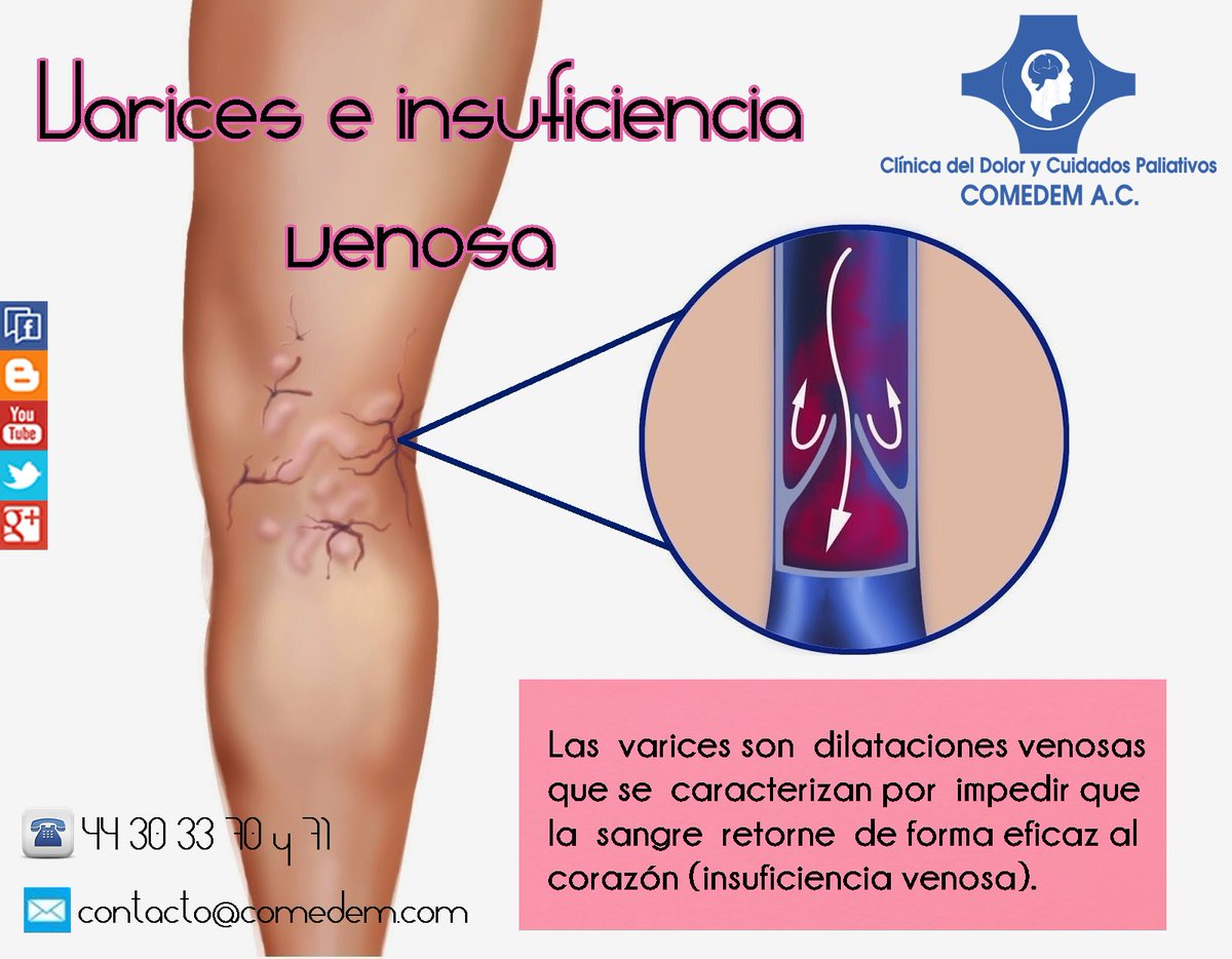clinicadldolor_'s tweet photo. VARICES E INSUFICIENCIA VENOSA #Comedem #CDMX
¡Visita nuestro blog para informarte!
https://t.co/tV6EPf6bYc https://t.co/a4pZvCWYTc