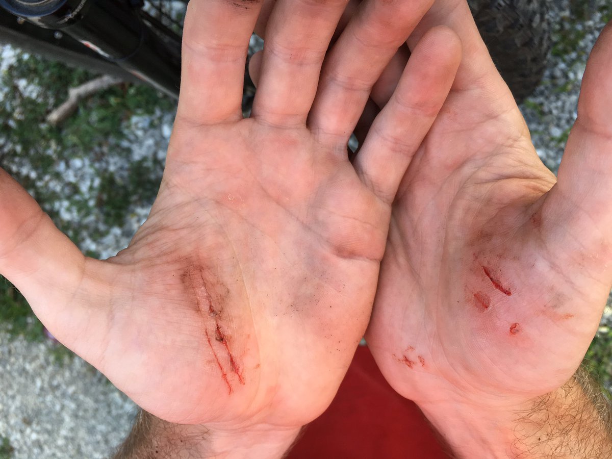 yclphoto's tweet photo. Oh yeah, and this happened yesterday along with a broken front derailleur. #mtb #crashboom https://t.co/xfvzIyuaCa
