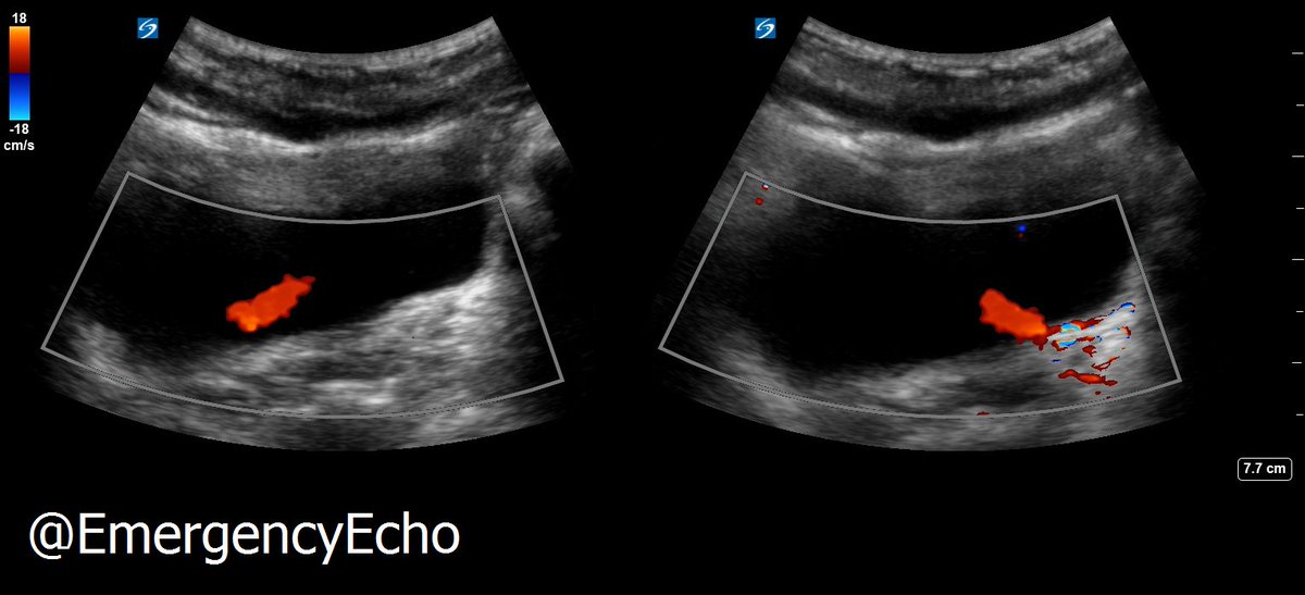 Look for ureteric jet on the sore side in flankpain pts - if present, this excludes total obstruction #POCUS #FOAMus