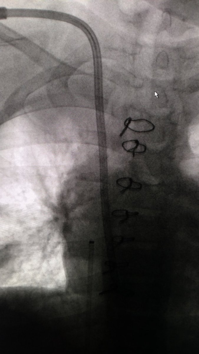 LessneVIR's tweet photo. @SIRspecialists Young teen with flush svc occlusion #rfwire + #IRmagic = #groincathout https://t.co/b5WoucoEyA