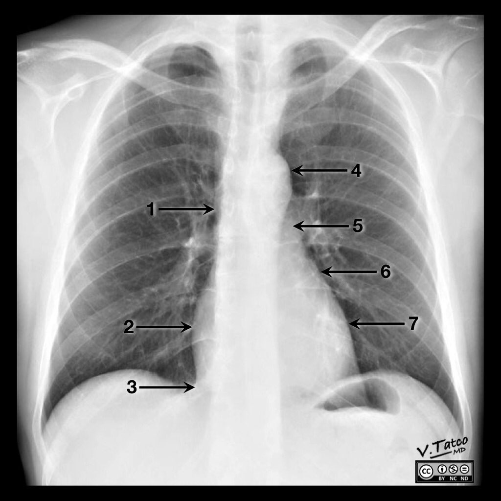 AfJEM's tweet photo. .emergencymedke: RT DrAndrewDixon: Great chest x-ray #anatomy case by DrVinceTatco on Radiopaedia. #FOAMed #FOAMra… https://t.co/Dgc4gzc42x