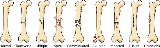 Long Bone Fractures

A diagram of different types 

#FOAMed #CPD #Retweet