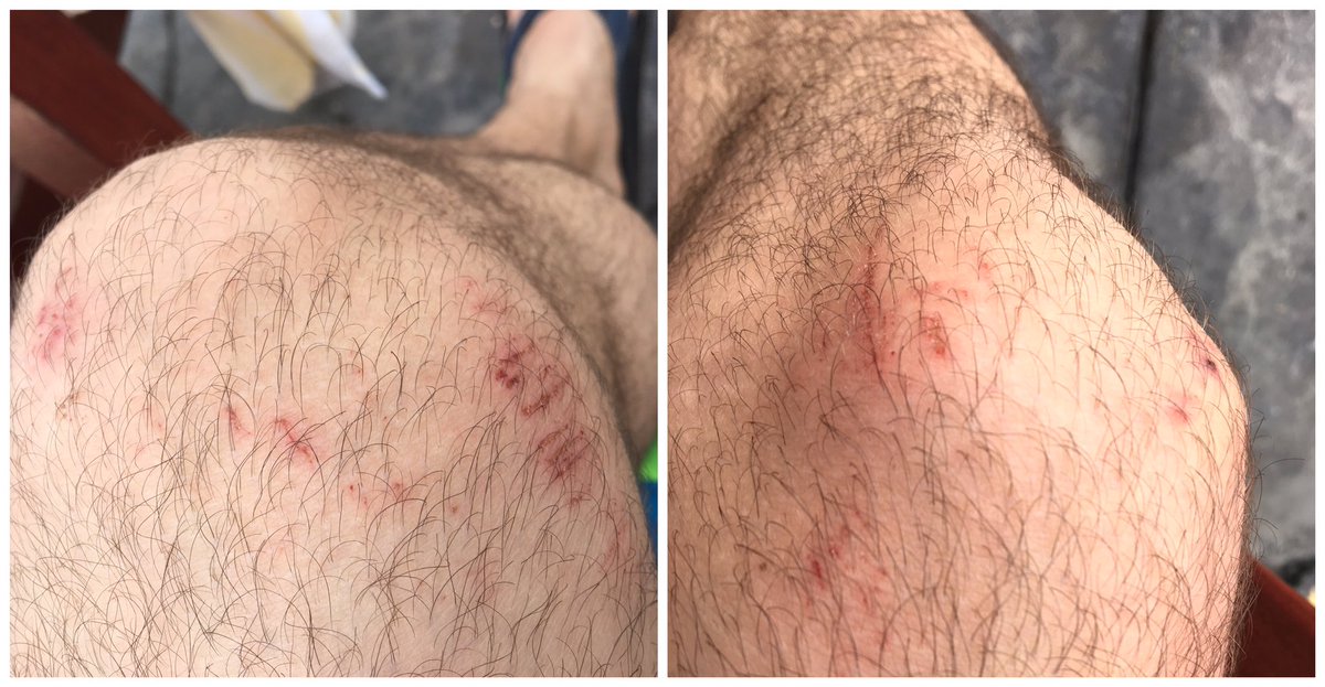 prgarc's tweet photo. That time I fought the coral reef and lost. 🏊🏻🐠🐚
#firsttimesnorkeling https://t.co/7tqFCf02kS