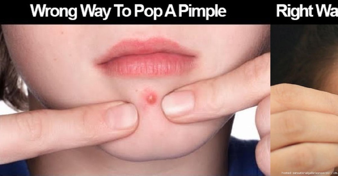 versnelling Phalanx alleen AQUARIUS Astrology on Twitter: "How To Properly Pop A Pimple Without  Leaving A Scar https://t.co/UrkTFGY8T1 https://t.co/XxIByufEQ6" / Twitter