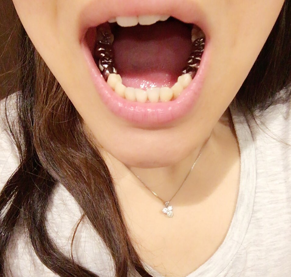 R 過食嘔吐の代償 歯がボロボロ 笑うと見えるの恥ずかしいよね R 過食嘔吐の代償 歯がボロボロ 笑うと見えるの恥ずかしいよね