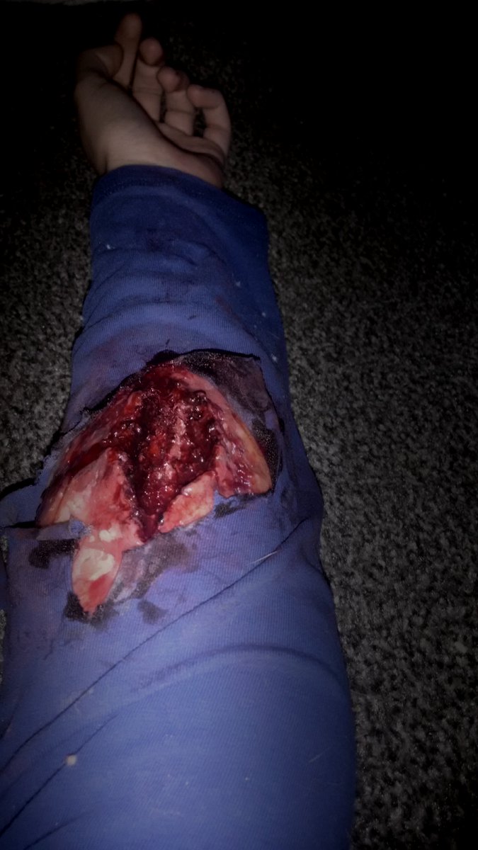 latest look bite wound, go check out my Instagram,  instagram.com/griffiths_sfx/ #wound #bite #blood