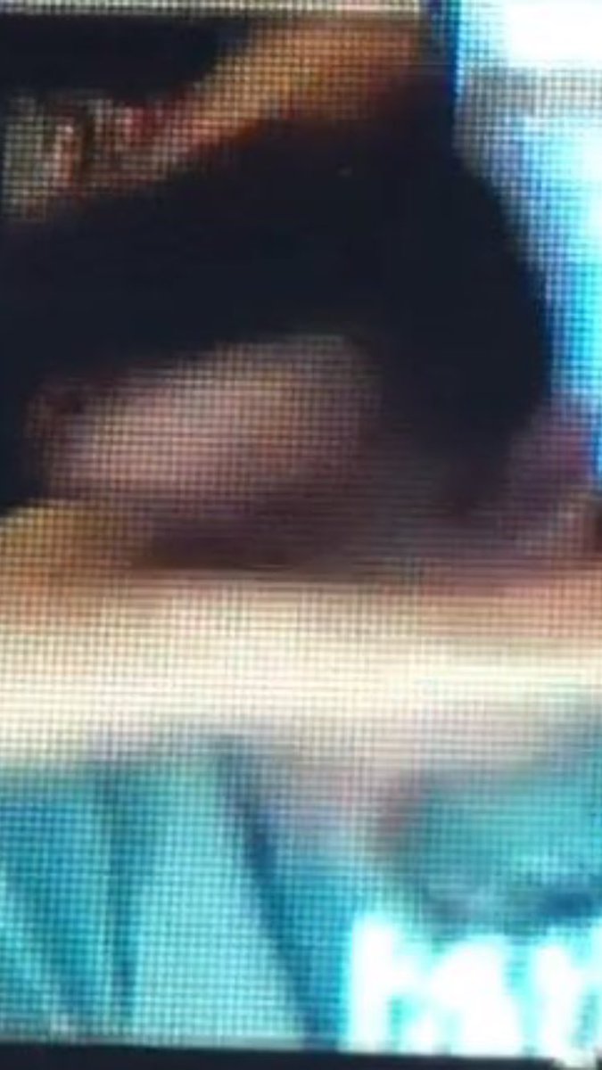 CSBHairline's tweet photo. Exposed https://t.co/z07j313qGg