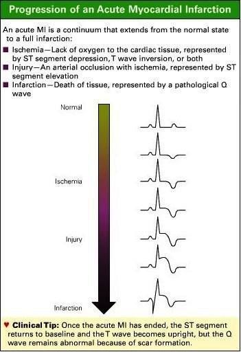 Progression of an acute myocardial infarction