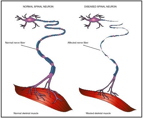 Motor neurons carry electrical impulses to effector tissues, but the muscles atrophy with the disease.