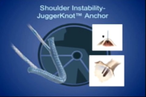 theshoulder's tweet photo. Shoulder Instability Jugger Knot Anchor https://t.co/4JOWcRJ8S6 #joint #shoulderjoint #doctor #surgeon #tissue https://t.co/tfjETYD3ro