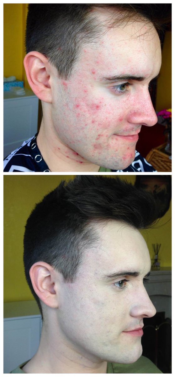 Skin imperfection/acne camouflage makeup is now available for men at Top Secret Makeup Studio in Congleton. Only £20