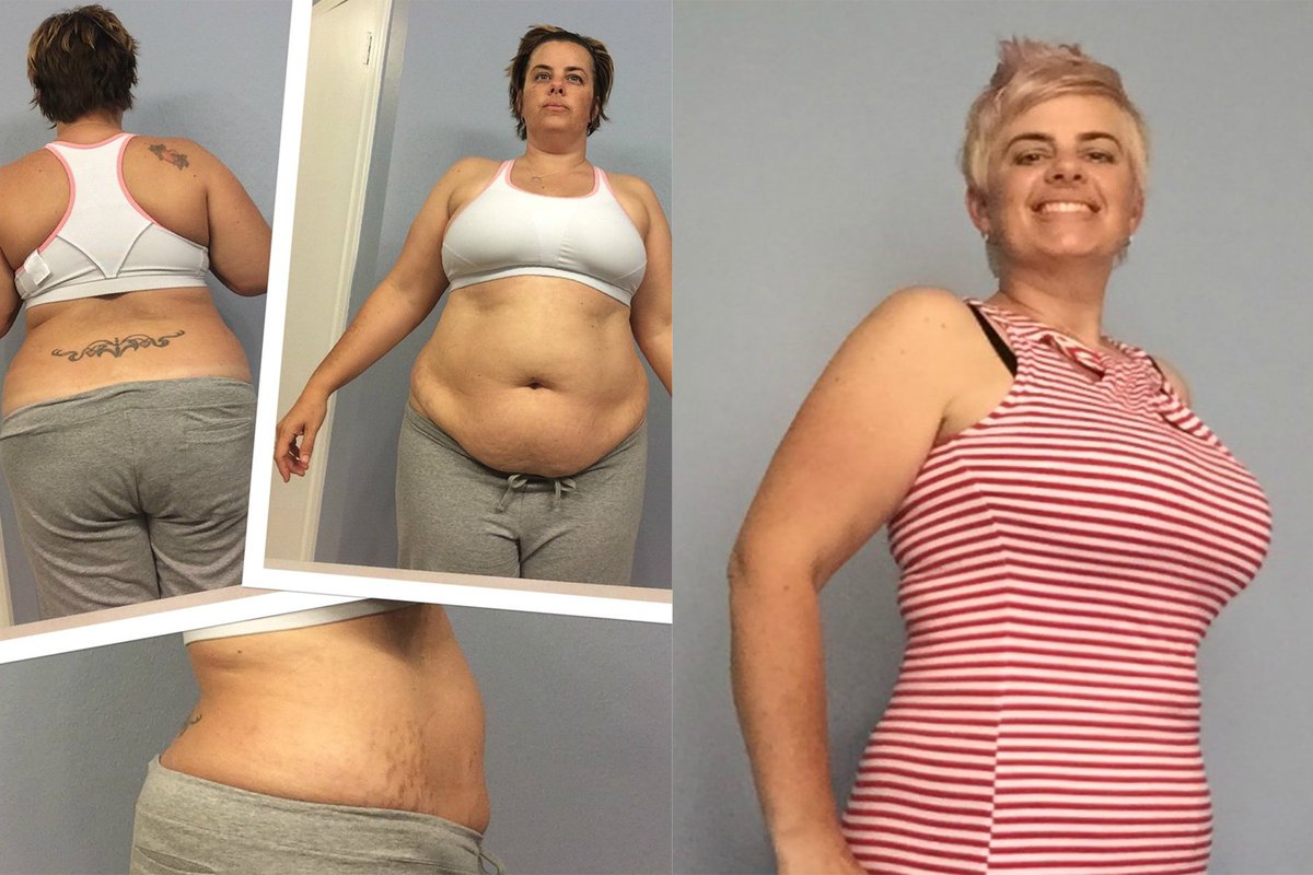 EvolveBariatric's tweet photo. Jennifer had the #gastricsleeve here at #EvolveExperts.Read her story ->https://t.co/HKfF8Rgtit #TestimonialTuesday https://t.co/jWbHF8719C
