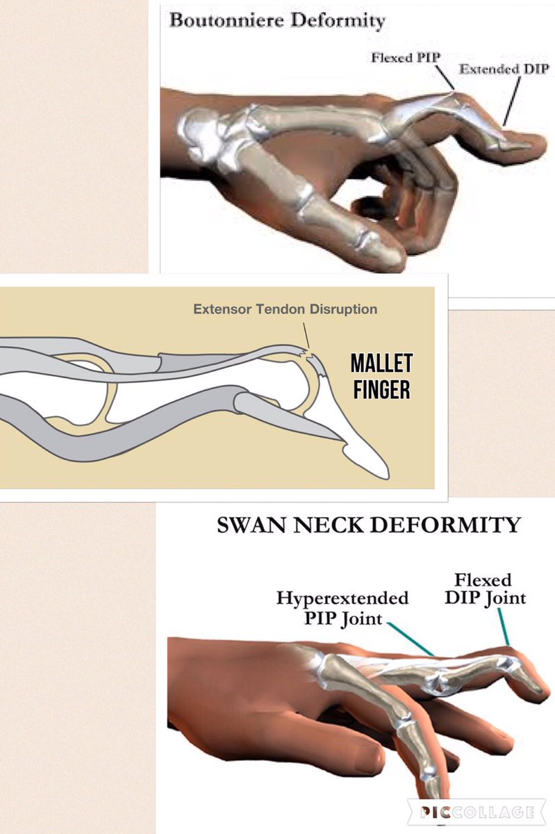 Swan Neck Deformity