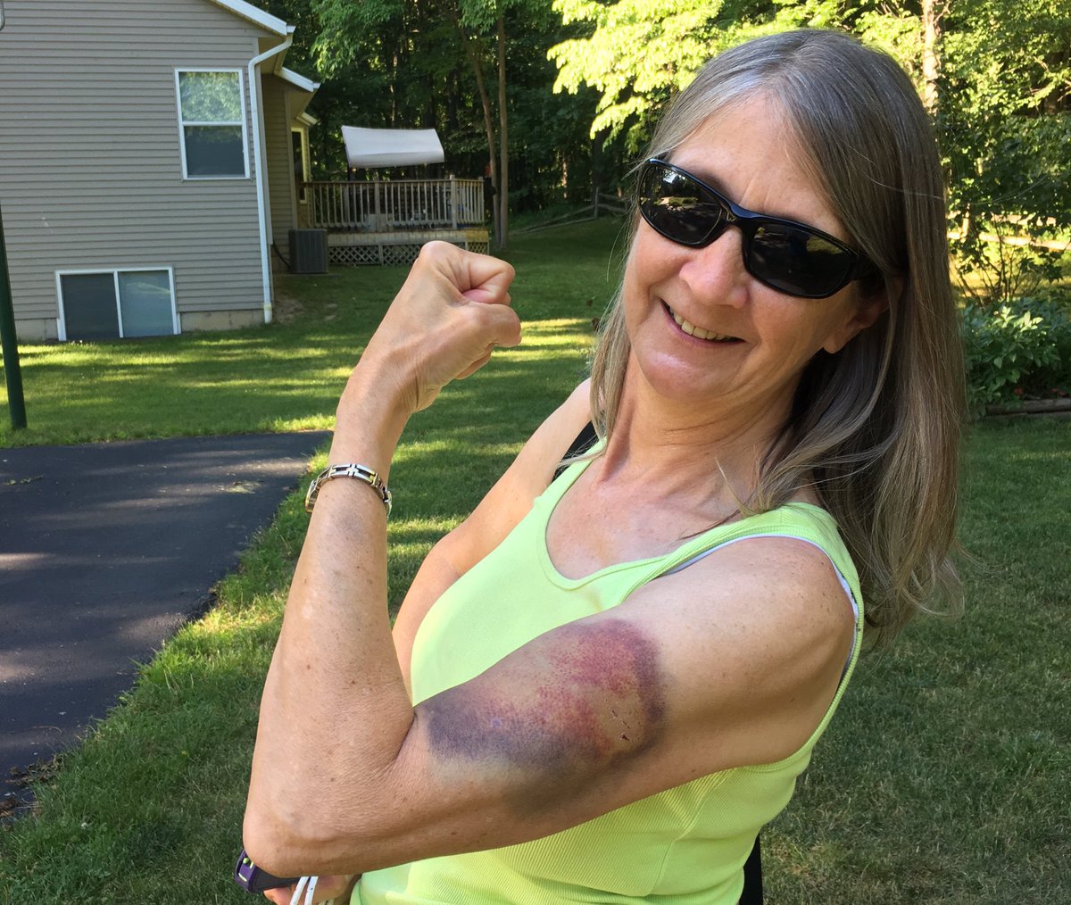 WildlifeBioGal's tweet photo. My mom is one tough cookie...sporting the big ol' bruise from the parents' trip to Isle Royale. #SlipperyRocks https://t.co/73V2HpXYox