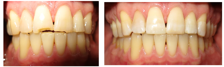 BrandonEash_DMD's tweet photo. #ToothColor is complex. Front teeth are whiter than back teeth - even the same tooth has color changes within! https://t.co/LnYFCmgpxB