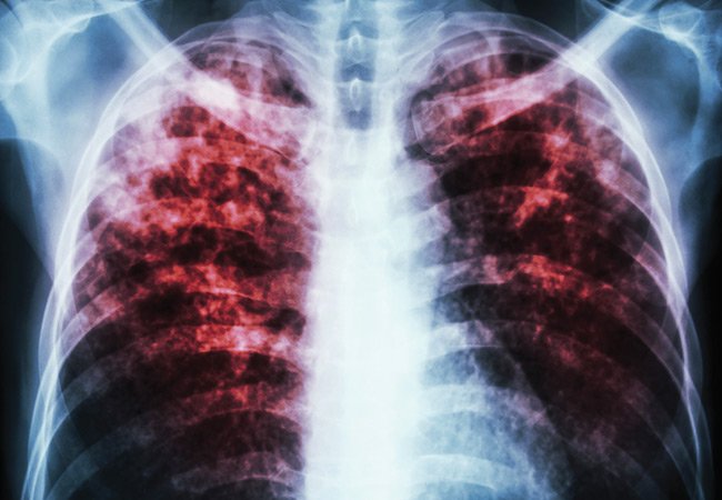 CleClinicMD's tweet photo. Recent therapeutic advances for adult cystic fibrosis offer dramatic results https://t.co/NPGQ4OWaSz https://t.co/4XC7IKPuIq