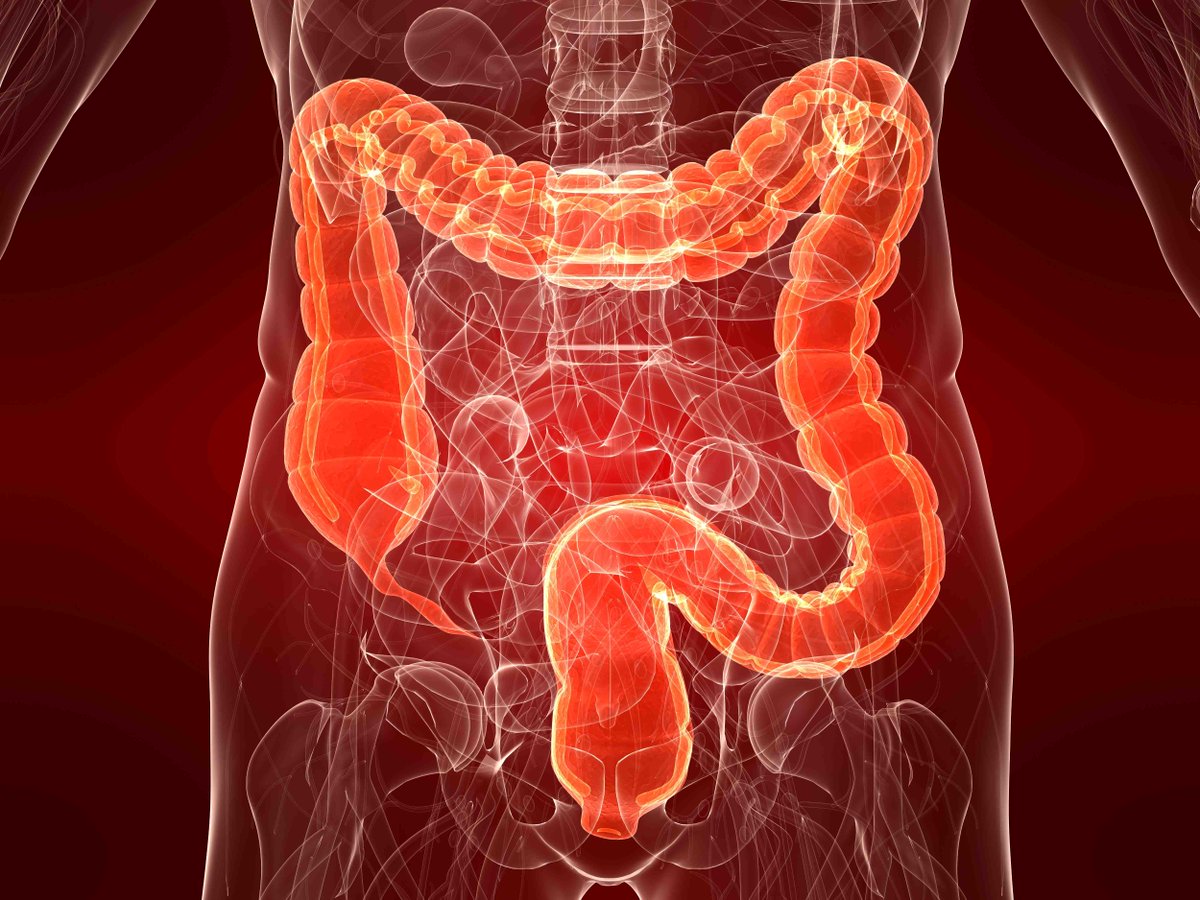 Image result for cancer colorretal
