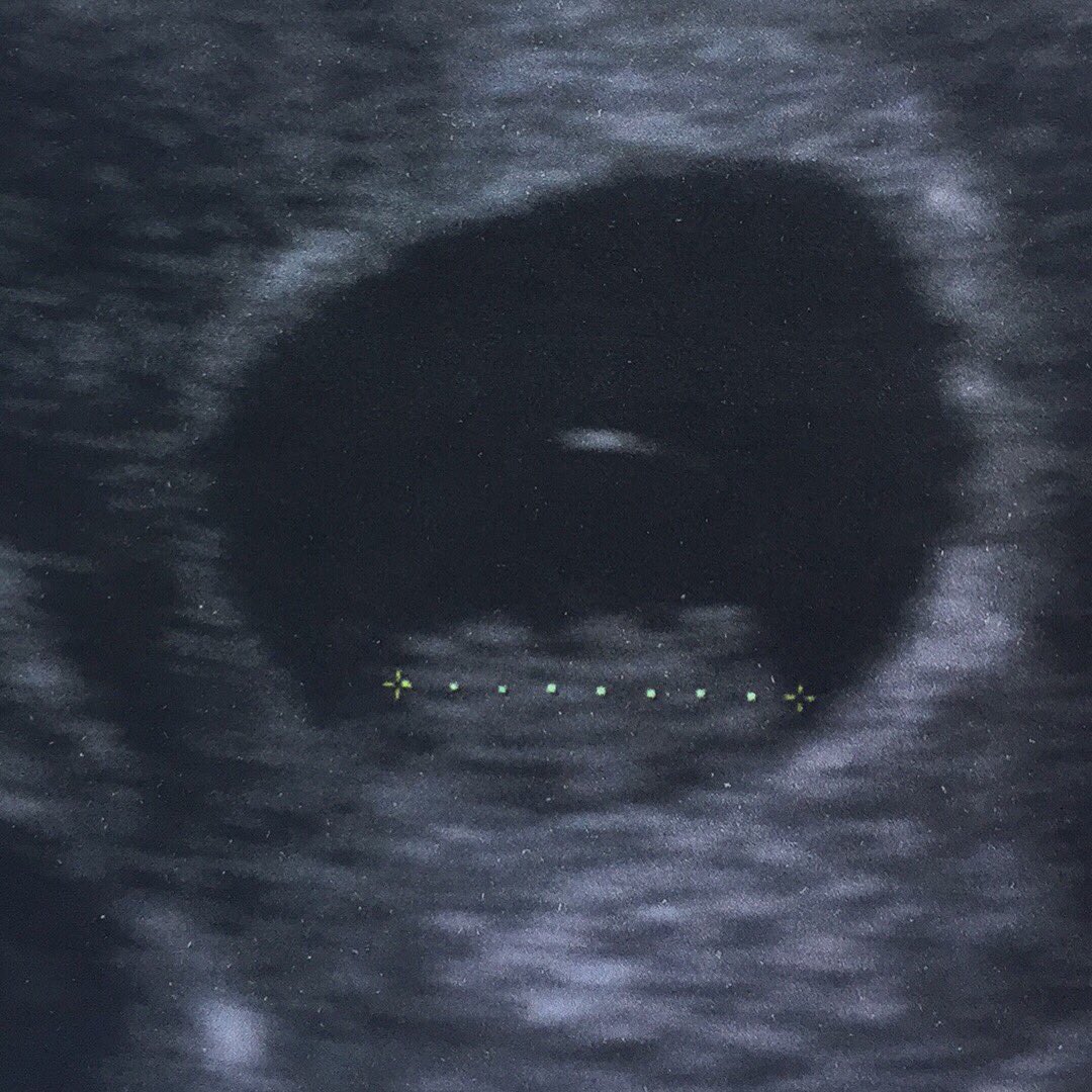 Escuchar por primera vez el latido del corazón de tu hijo no tiene precio!
Gracias Dios por este milagro! 
#8semanas