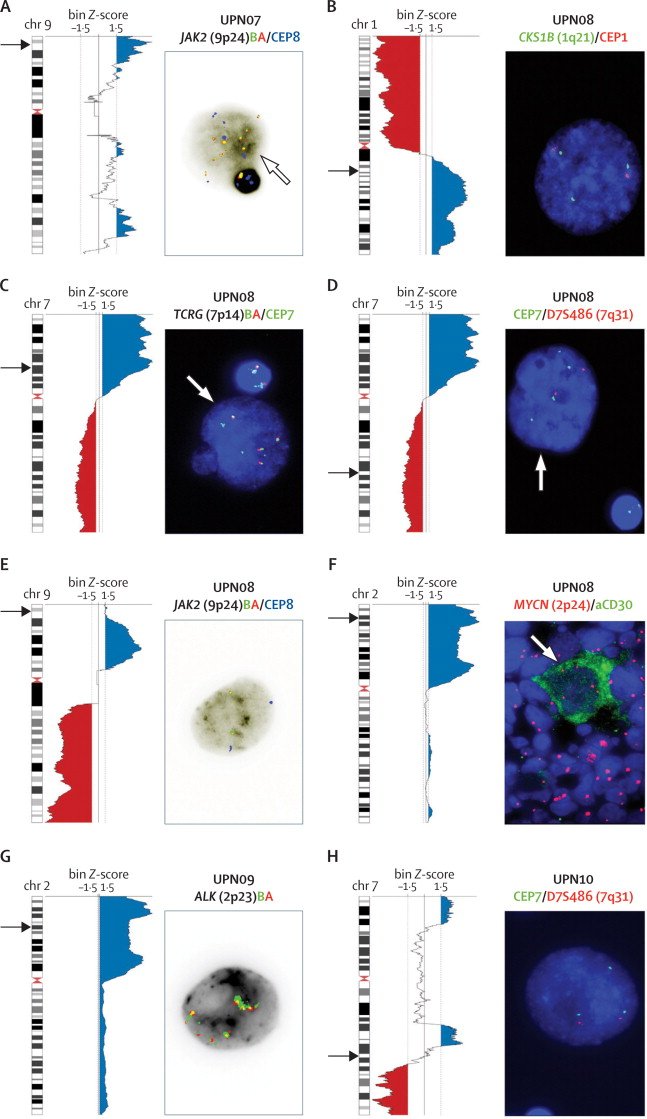 evemariecrane's tweet image. #CellFreeDNA detects Hodgkin/R-S genomic imbalances in early &amp;amp; advanced disease. MRD next? ncbi.nlm.nih.gov/pubmed/26687610