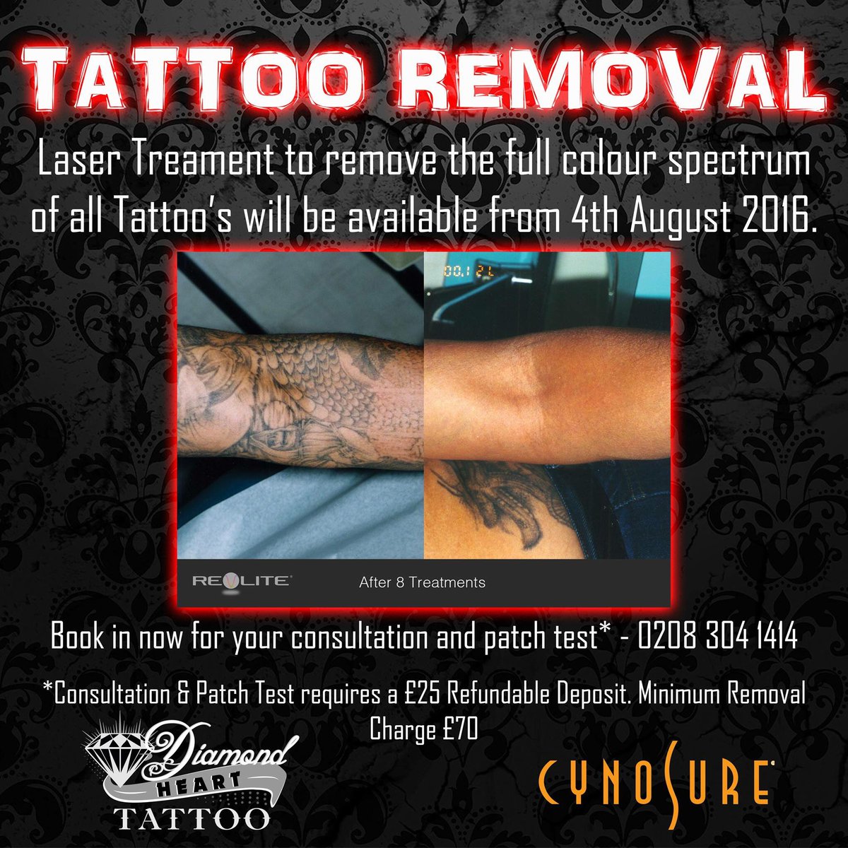 Diamond Heart Tattoo Bexleyheath Laser Tattooremoval Revlite Cynosure Goldstandard Fdaapproved T Co Ogdffxwwue Twitter