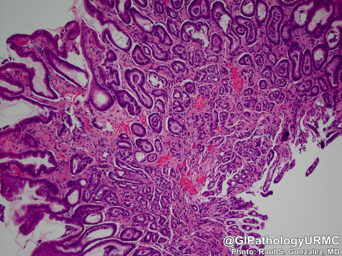 Urmc Gi Pathology On Twitter Gastric Antral Vascular Ectasia Gave Watermelon Stomach On Endoscopy Https T Co Jn3zmpbprz Pathology Gipath Https T Co Kfwbs68jbj Twitter