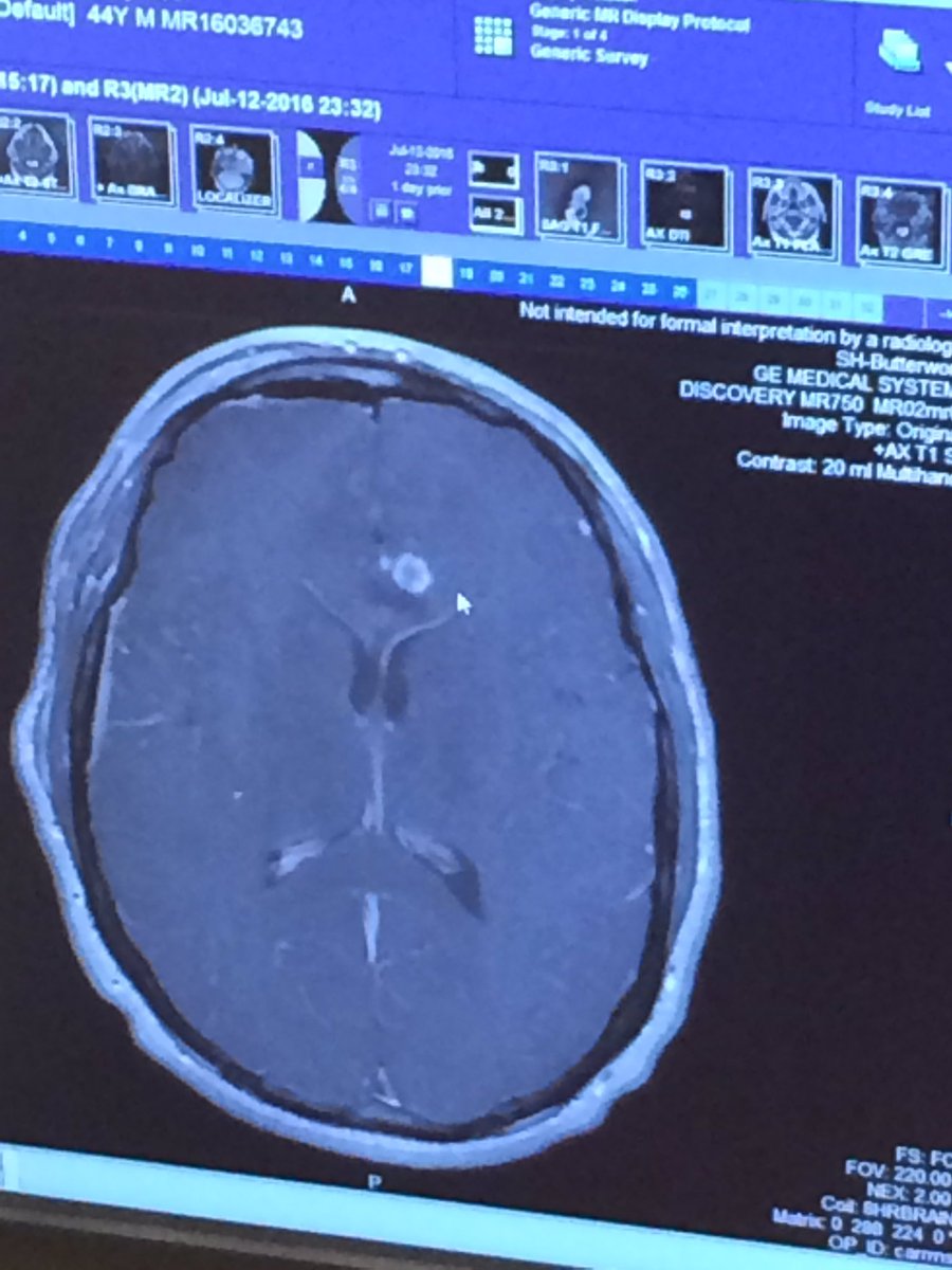 TK_AltEd's tweet photo. My brain tumor. Pre and post op https://t.co/72KC6AAnW2