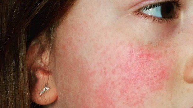 ‘slapped Cheek Syndrome A Common Rash In Kids More Sinister In