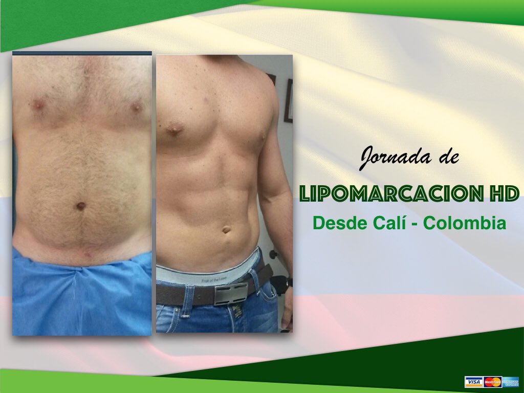 barragan_21's tweet photo. New body? Now is possible, #ExtremeMakeover #LipoHD https://t.co/GvHFDs13IA