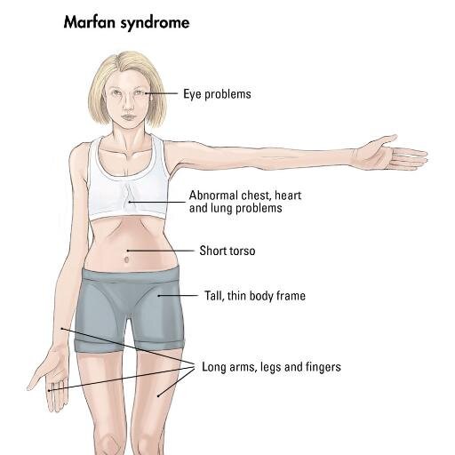 Marfan syndrome