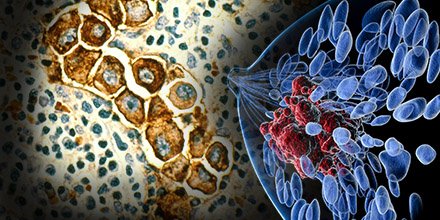 MDAndersonNews's tweet image. MD Anderson pioneers less severe breast cancer surgery: bit.ly/290YP0J @cancerfrontline #bcsm #endcancer