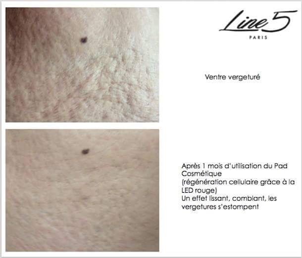 Line5Paris's tweet image. Témoignage en photo du ventre d une utilisatrice après 4 grossesses 
contact@line5paris.com