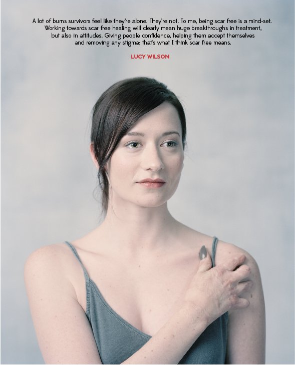 scarfreeworld's tweet photo. Our stories with @LucyLWilson ... #scarfree https://t.co/eNNWcuKYrE