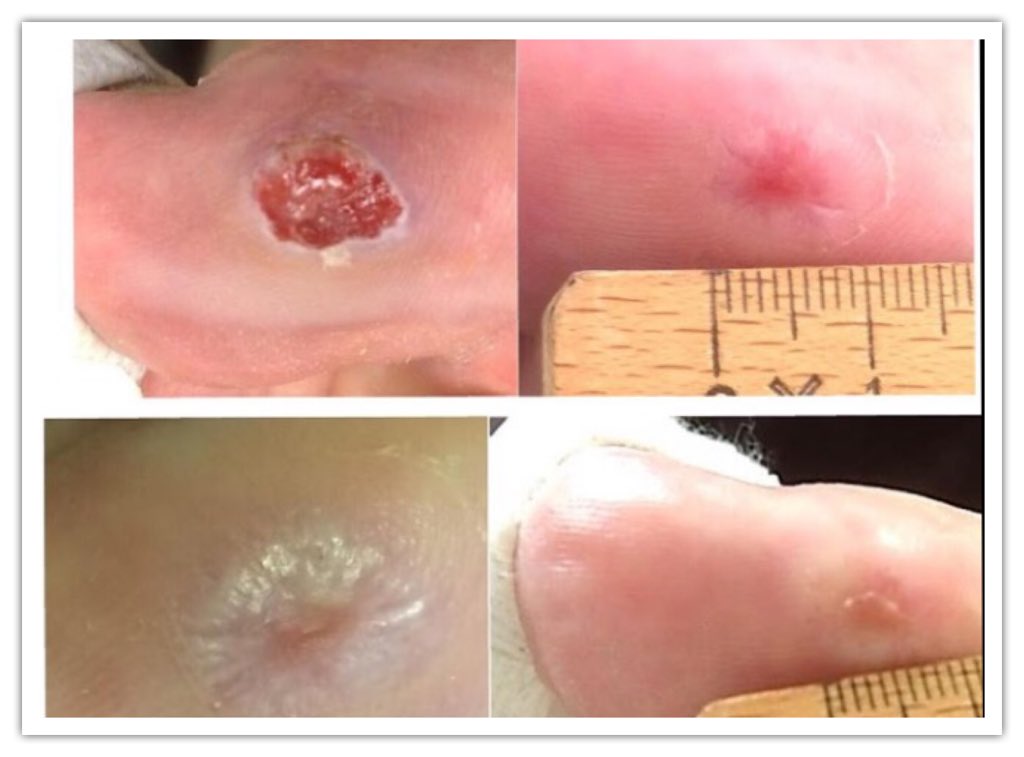 fagroniberica's tweet photo. Otro caso #Epifactor #ulcera 2,5 y evolucion #obesidad ....No responde a ttos habituales. https://t.co/MxgvmU3MJF https://t.co/5eYH1s9TMR