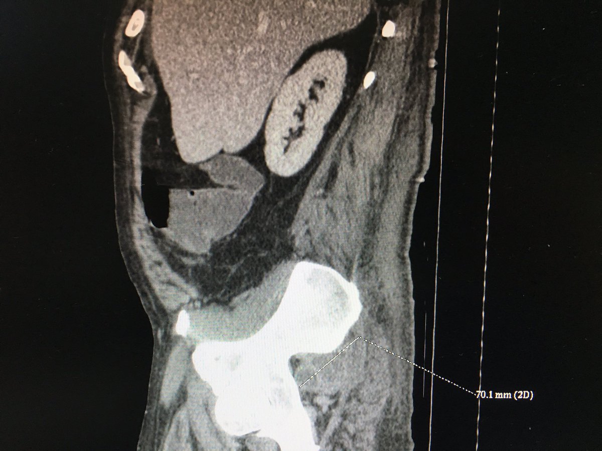 corralmunar's tweet photo. #gluteus #abscess #staphylococcus #muscle #CTguided drainage #CT scan #muscle #CTguided #opendrainage #hip #pelvis https://t.co/i46KWsvXH3
